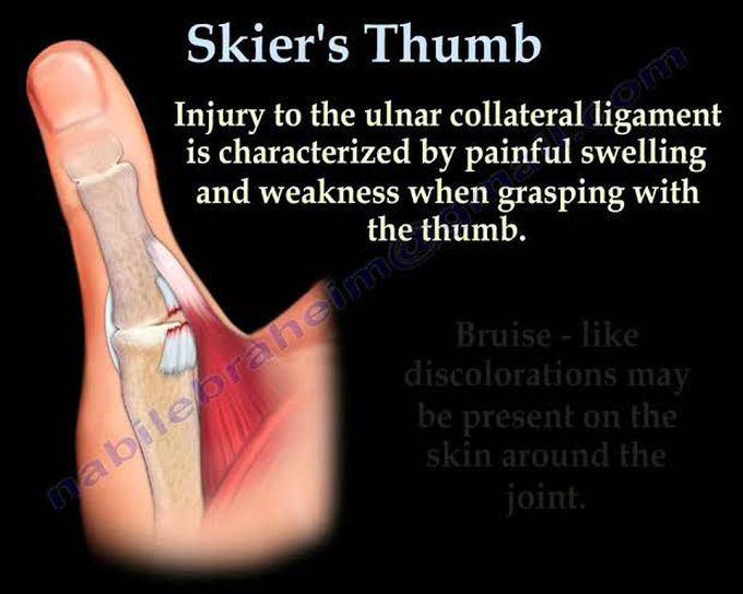 Skier's Thumb