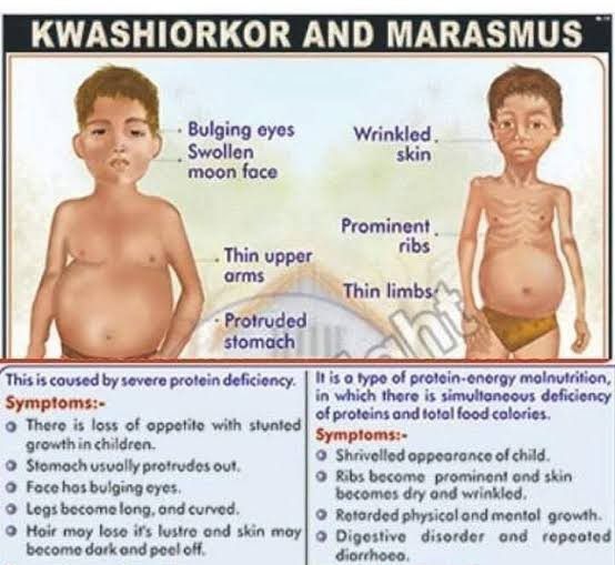 Kwashiorkor and marasmus - MEDizzy