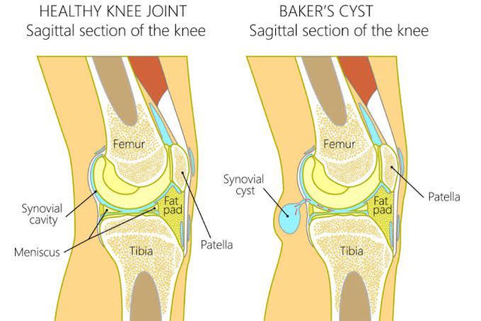 Baker's cyst