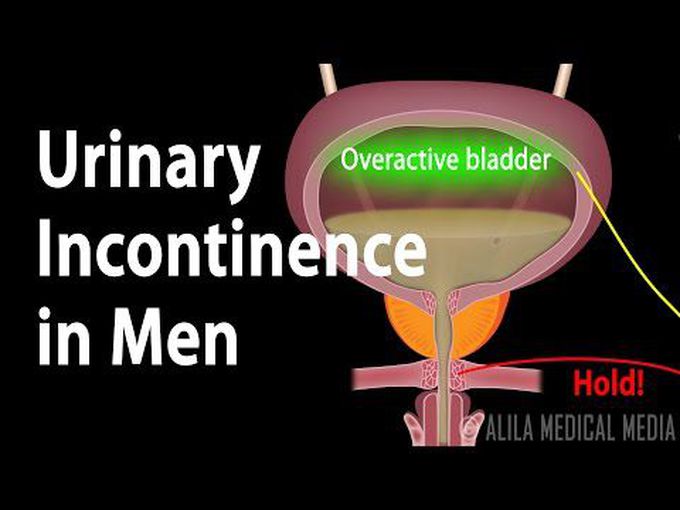 Male Urinary Incontinence