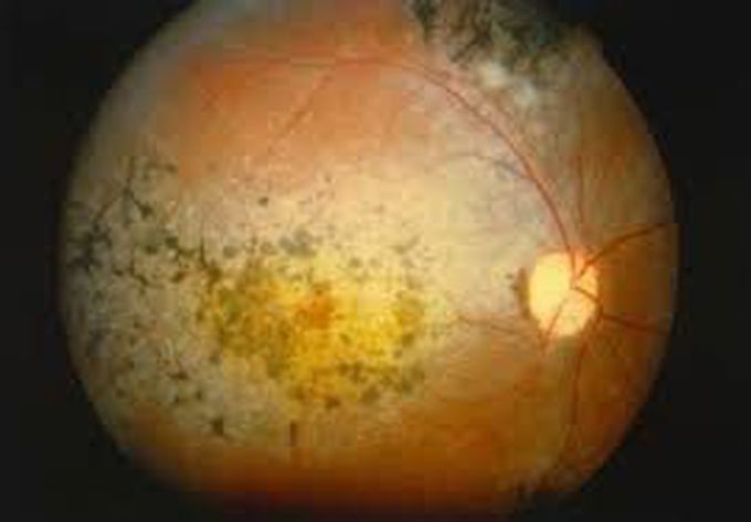 Symptoms of retinitis pigmentosa