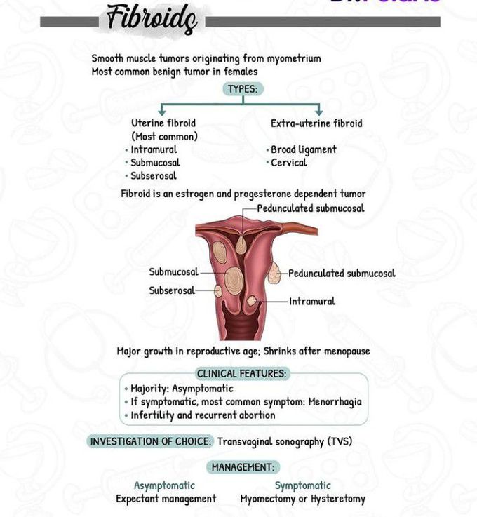 Fibroids - MEDizzy