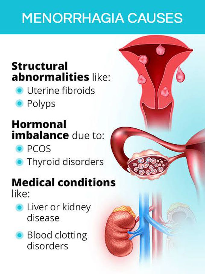 Causes of menorrhagia