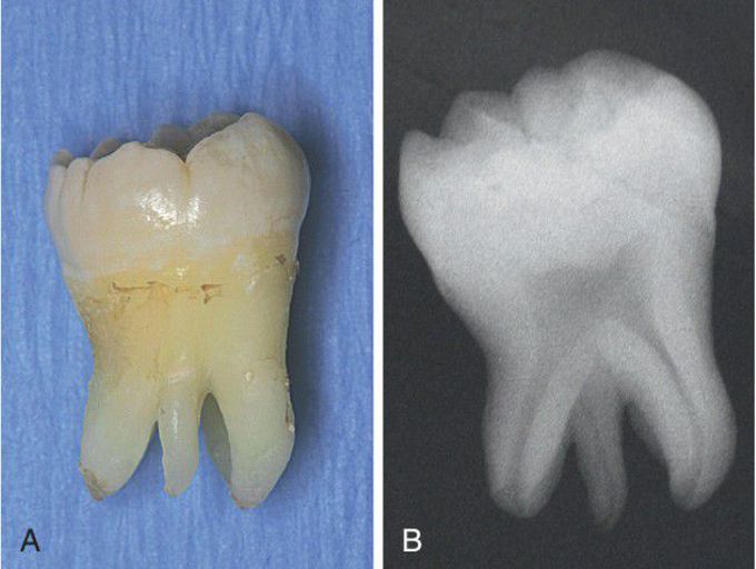 Supernumerary root