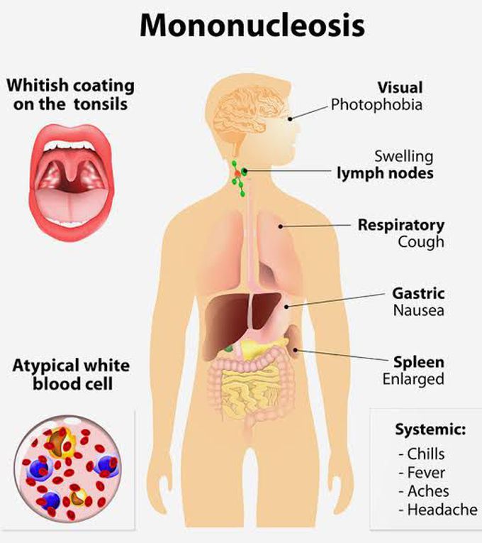 These are the symptoms of Mononucleosis