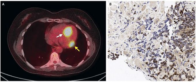 Cardiac Metastases in Melanoma