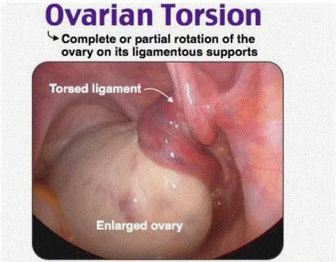 Treatment of ovarian torsion