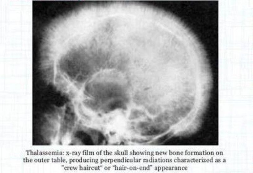 Crew cut (named after the hair cut) appearance of skull seen - MEDizzy