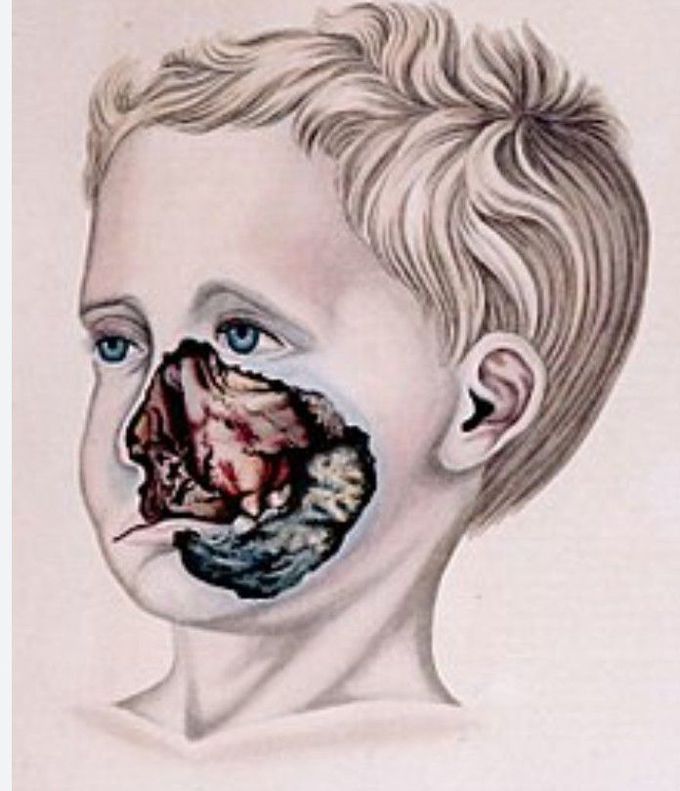 What is Noma disease?