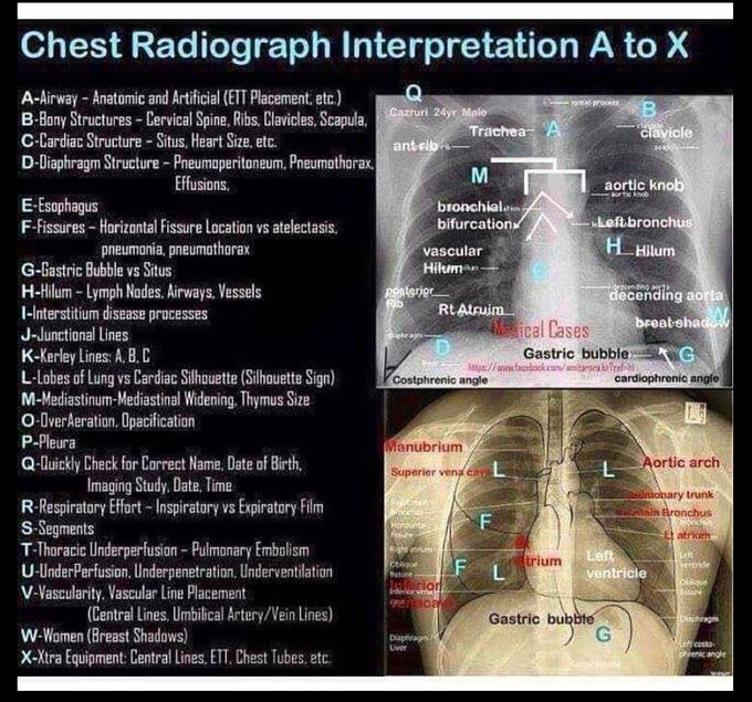 Easy way to interpret chest x-ray