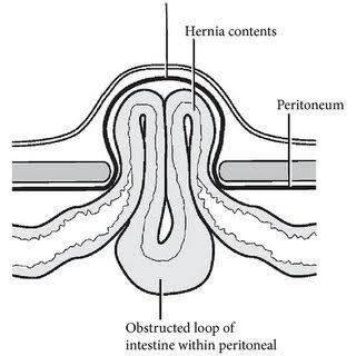 Maydl's Hernia - MEDizzy