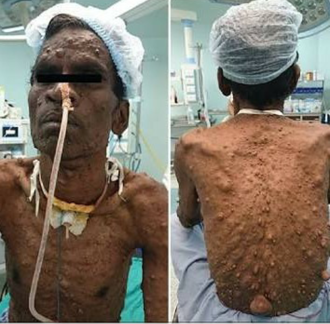 Von recklinghausen syndrome