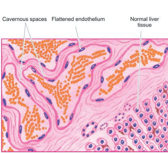 Cavernous haemangioma of the liver