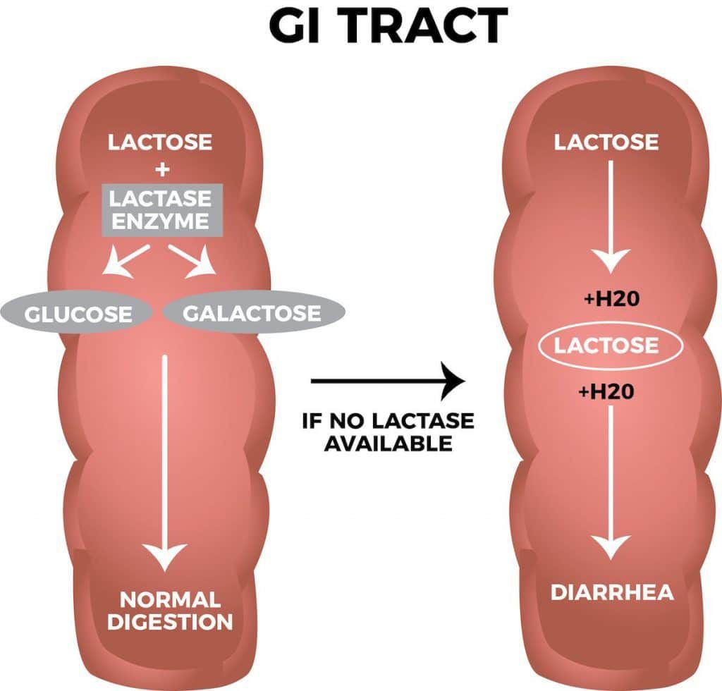 Lactose Intolerence MEDizzy