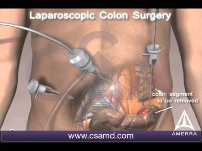 Colorectal Cancer Surgery 3D Medical Animation - - MEDizzy