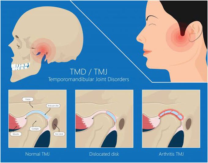 Treatment of internal derangement