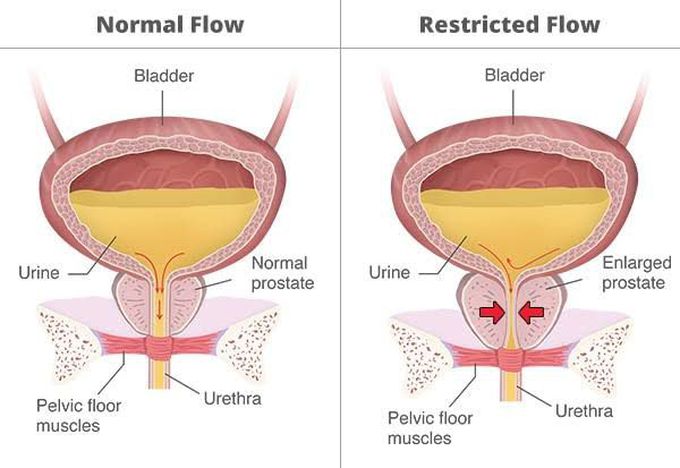 Symptoms of urinary retention