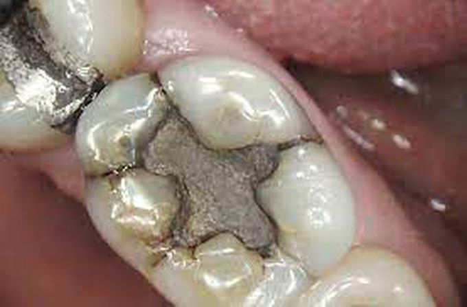 Dental amalgam