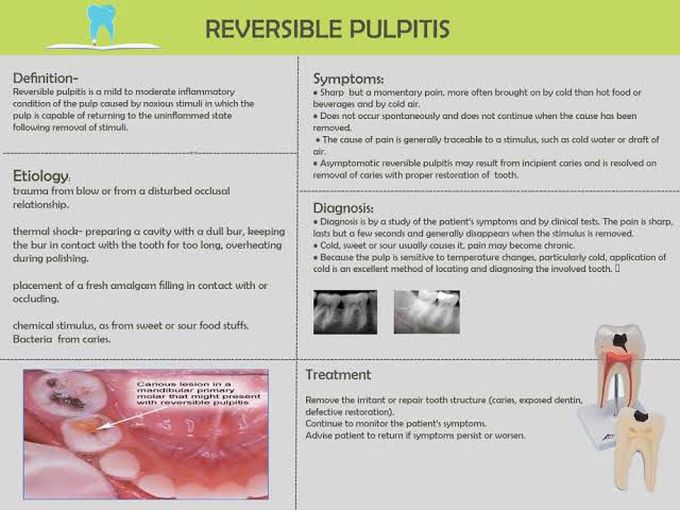 Reversible pulpitis