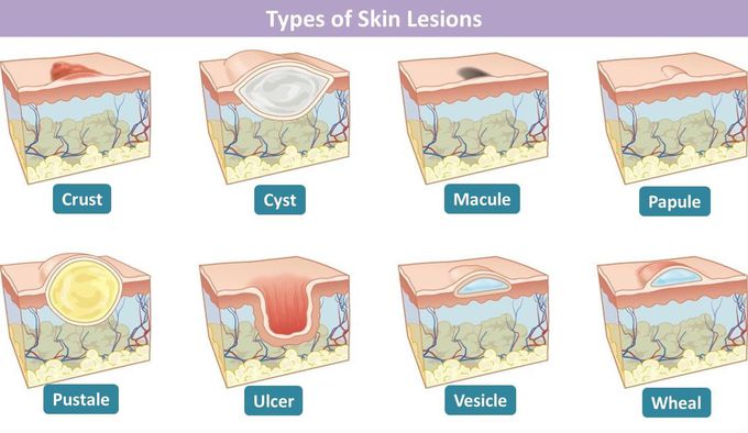 Skin lesions and abnormal for skin layers