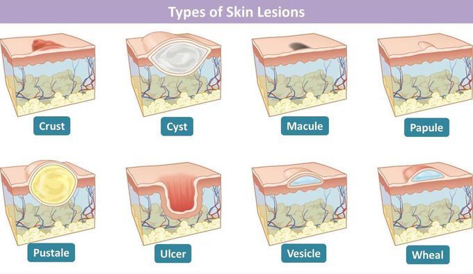 Skin lesions and abnormal for skin layers - MEDizzy