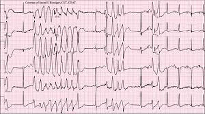 Torsades de pointes