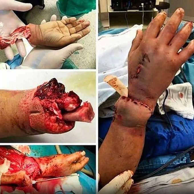 Hand replantation