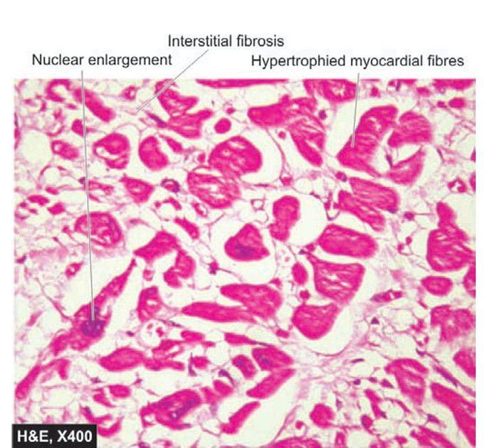 Cardiac hypertrophy.