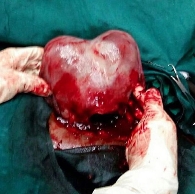 Bicornuate uterus found during a cesarean section!! 