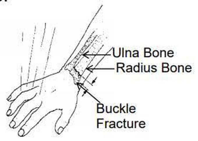 Buckle Fracture