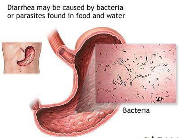 diarrhea-medizzy