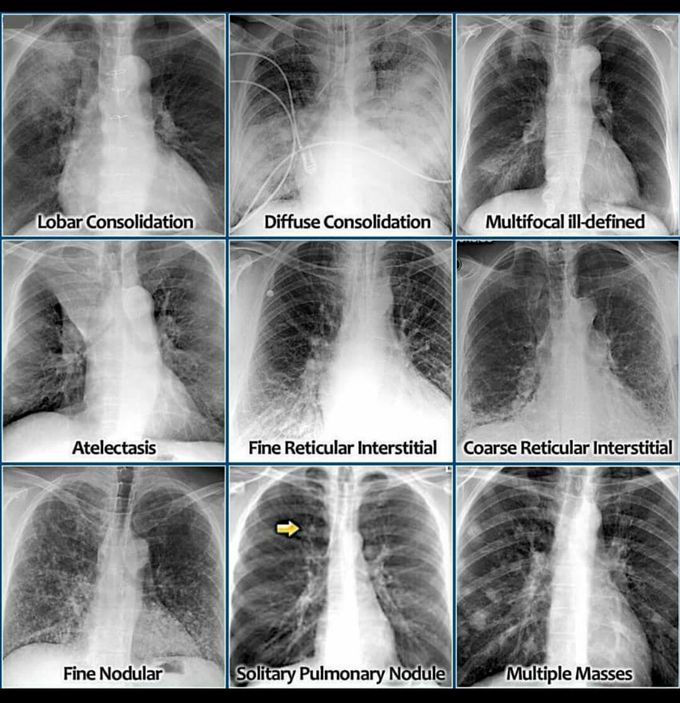 Chest X Ray Medizzy 