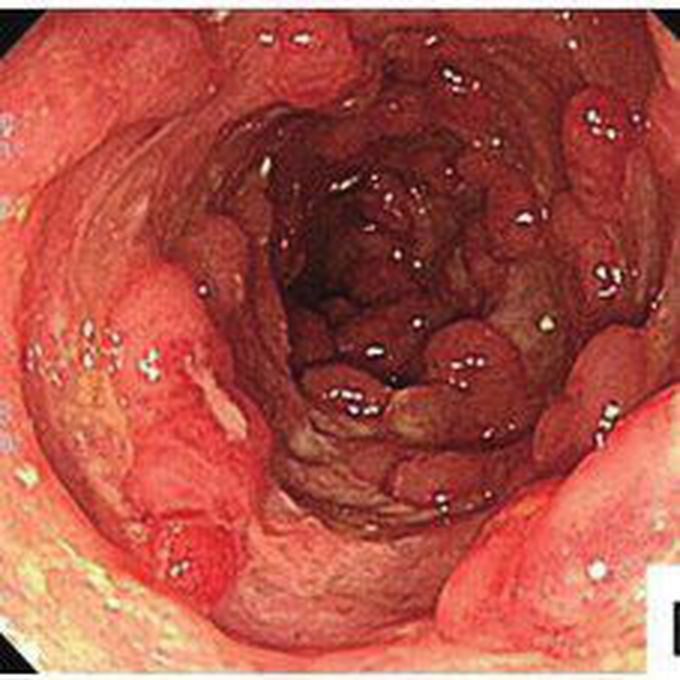 CROHN'S DISEASE