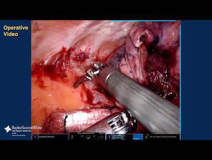 Robotic-Assisted TMR With LAA Exclusion