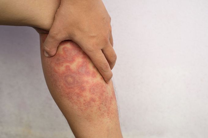 Symptoms of Eczema