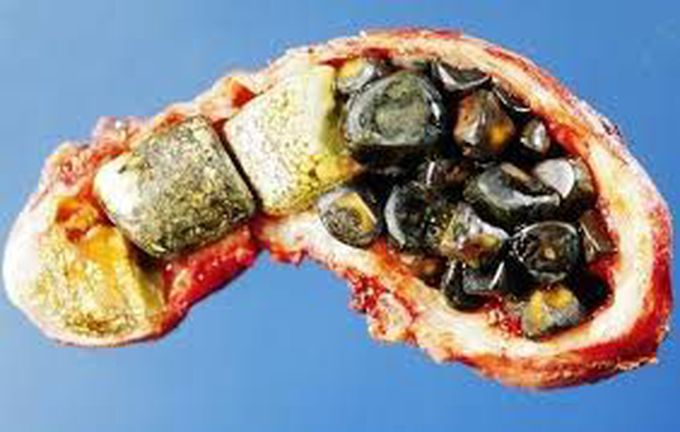 Cholelithiasis