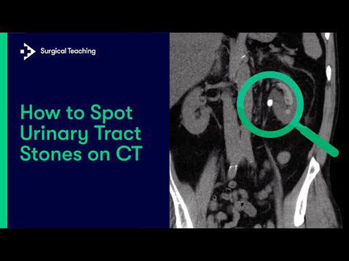 Diagnosis of Renal Stones On CT