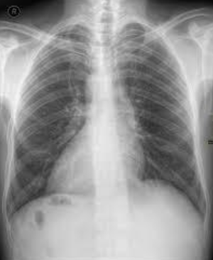 Chest Xray. AP view. - MEDizzy