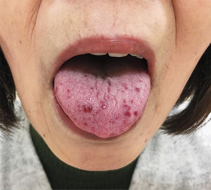 Tongue Telangiectasias in Systemic Sclerosis