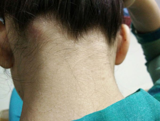 Swelling under hairline from last 10days ..red very tender with stiff neck ..can anybody help me with it