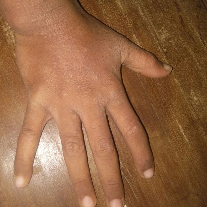 what is diagnosis...nd treatment
