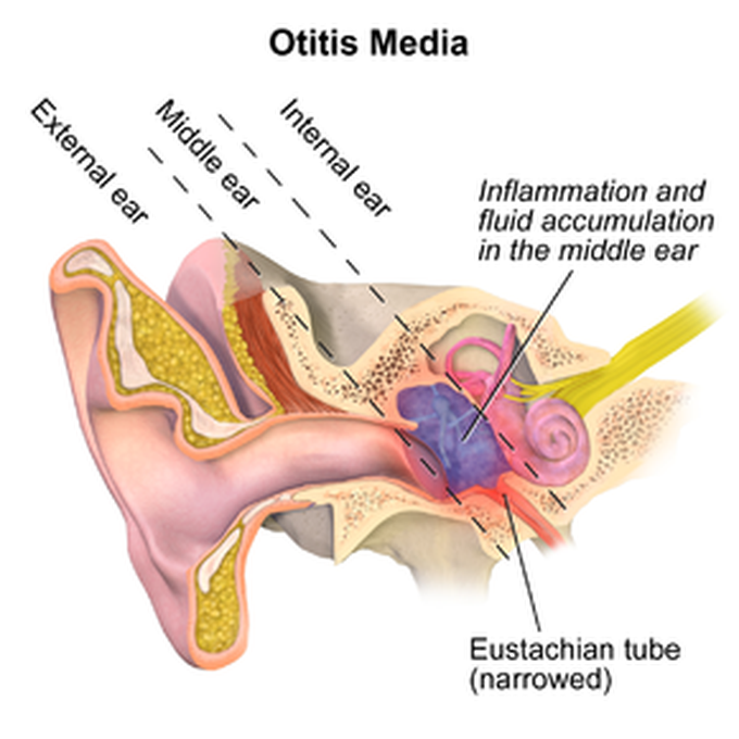 What causes an ear infection?