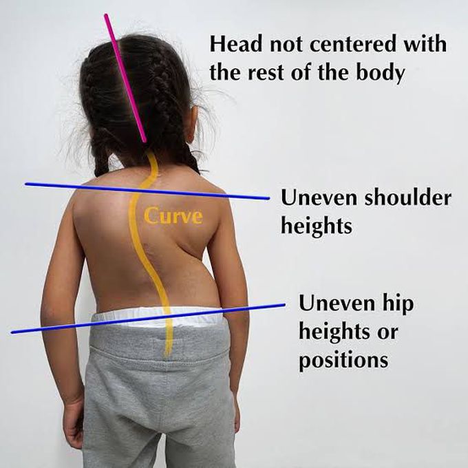 Treatment of scoliosis