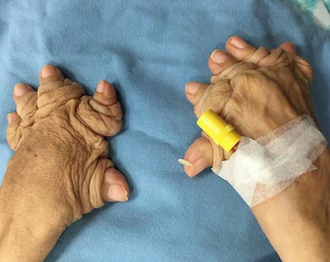 Telescoping fingers