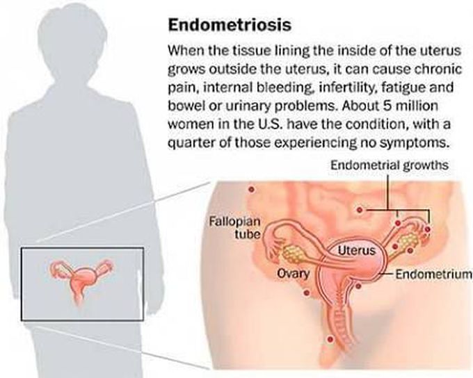 Endometriosis