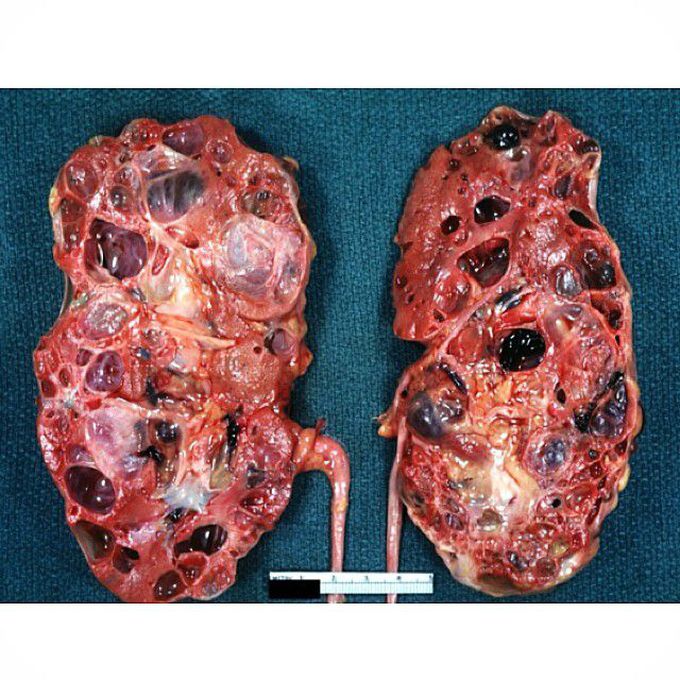 Polycystic Kidney Disease