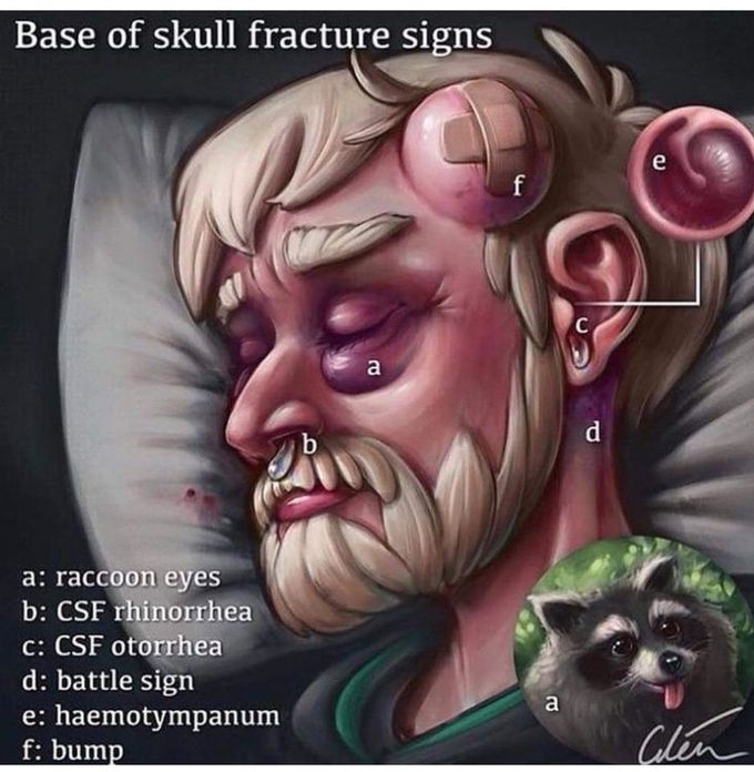 Base Of The Skull Fracture