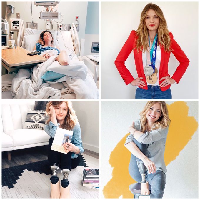 Amy Purdy❤️