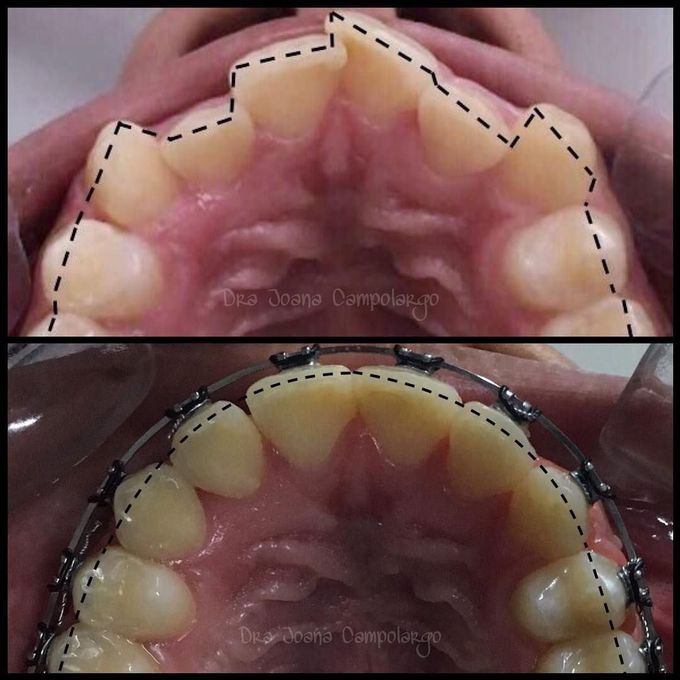 Correction of arch discrepancy