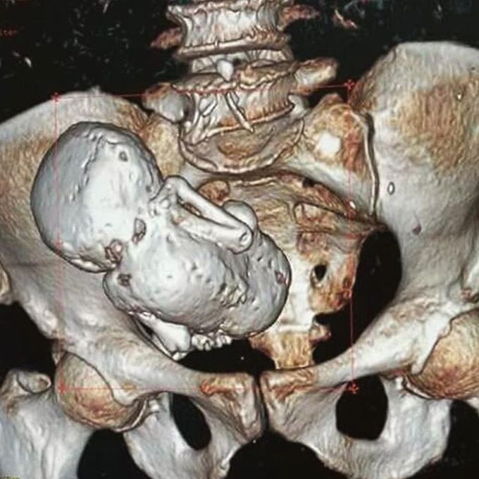 Calcified baby